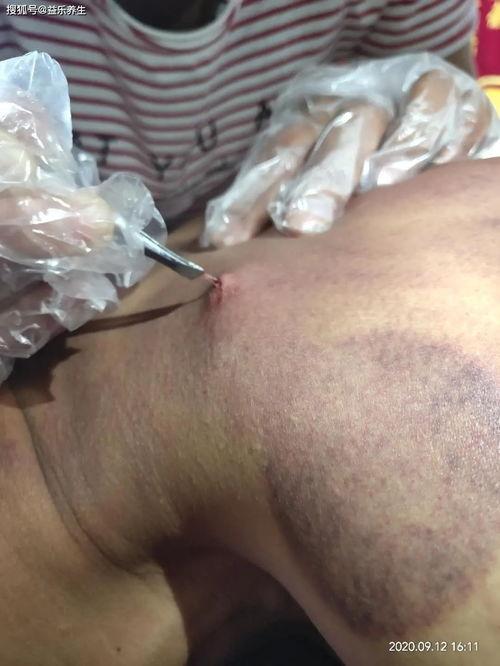 颈椎病挑羊毛疔视频,羊毛疔疗法视频详解