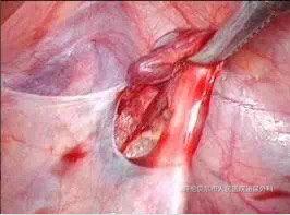 腹腔镜精索静脉曲张手术视频,腹腔镜精索静脉曲张手术操作步骤解析